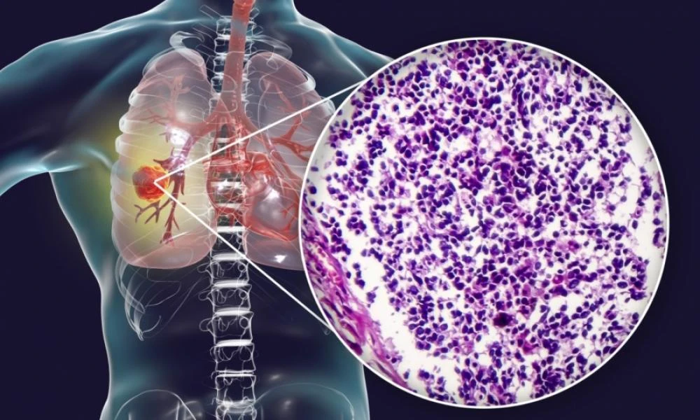 Καρκίνος του πνεύμονα: Ποια είναι η εξέταση που αναγνωρίζει τα πρώιμα στάδια